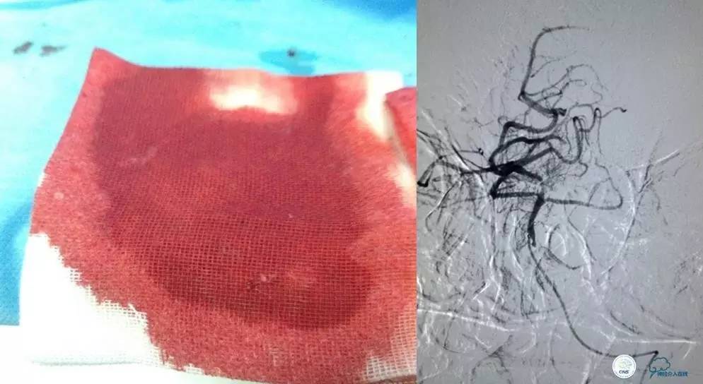 急性缺血性卒中静脉溶栓2018指南,急性缺血性卒中血管内再通标准