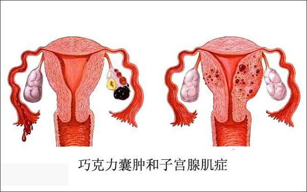 卵巢疾病的注意事项,卵巢囊性肿瘤注意事项