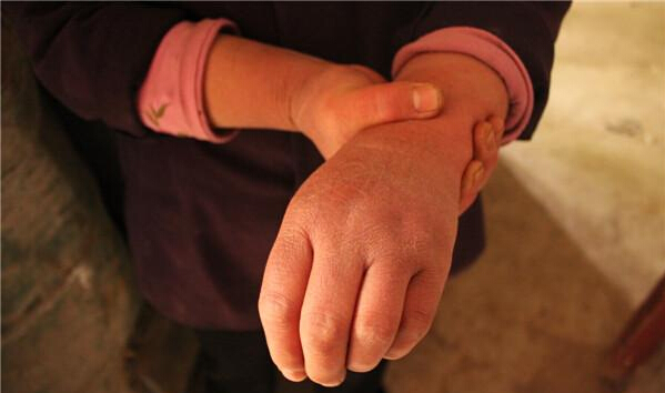 手腕关节炎的发病原因有哪些