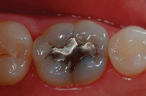 牙齿有矿物质怎么处理,牙齿有洞用什么充填