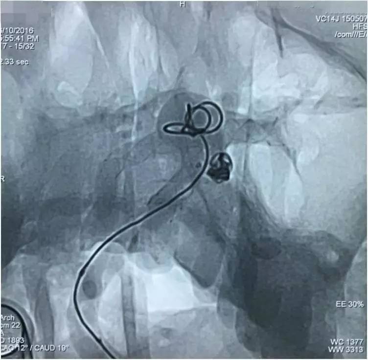 基底动脉顶端动脉瘤加左侧小脑上动脉瘤以Y型支架结合弹簧圈栓塞