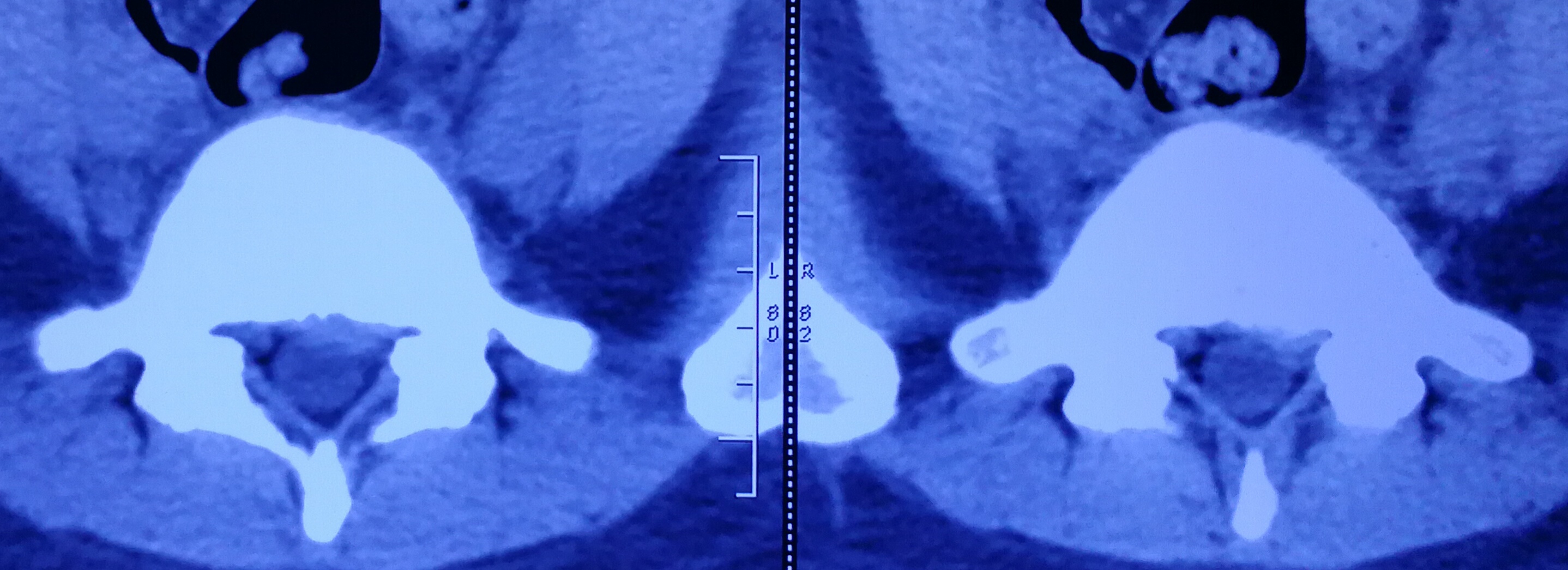 腰椎间盘突出怎么治疗好得快,女人腰椎间盘突出的亲身经历