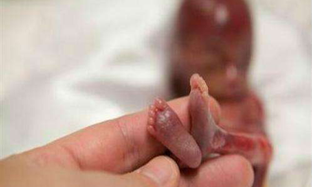 孕妇早产症状怎么办,孕妇早产是什么原因引起的怎么办