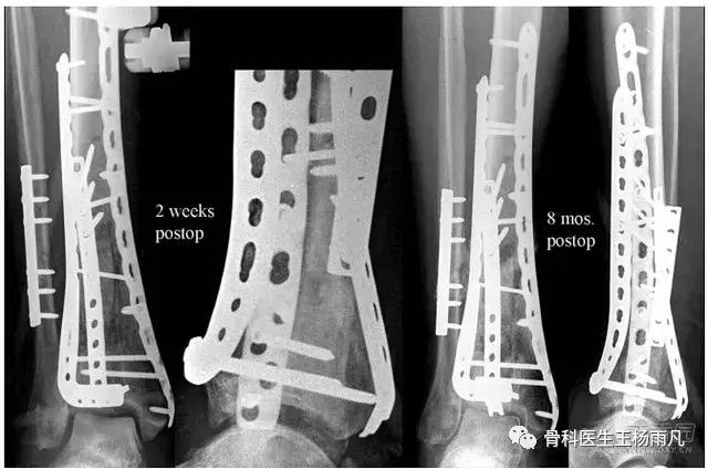 钢板要不要取下来,钢板需要取吗