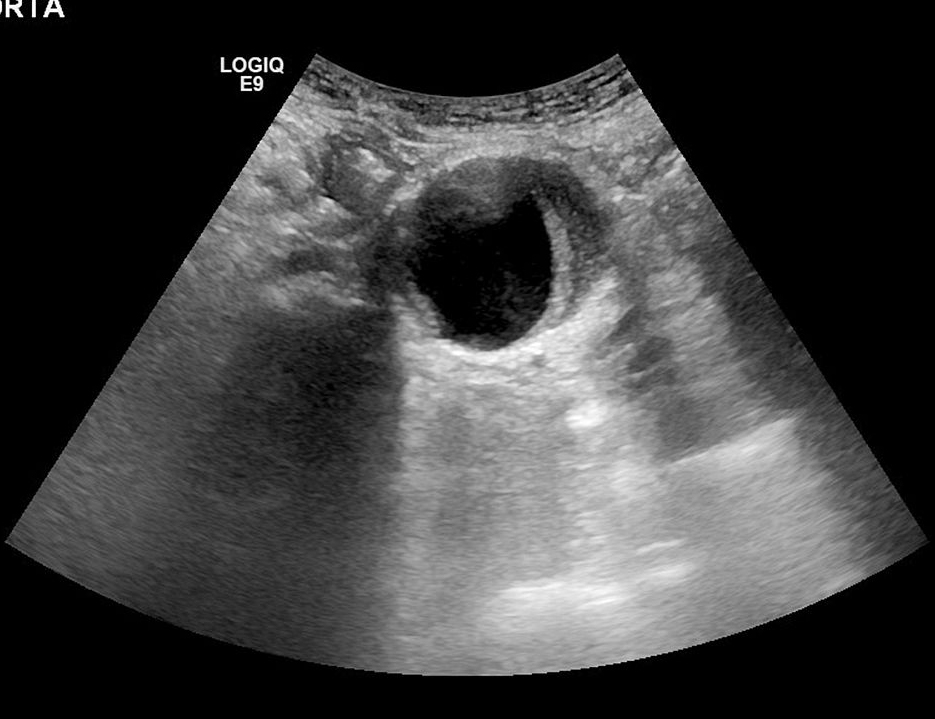 腹主动脉瘤的中医诊断,腹主动脉瘤手术费用是多少