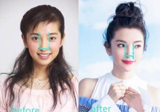 鼻翼怎么变小变好看的方法,鼻翼宽大怎么提升颜值