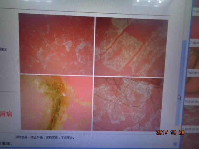 案例分享|四岁男童因误治变成沙皮人！