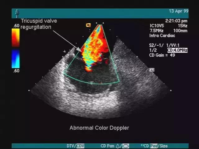 彩超的报告单结果是医生手打的吗,在医院做彩超报告是黑白的正常吗