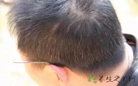 有少年白的建议染发吗,有少年白发的明星