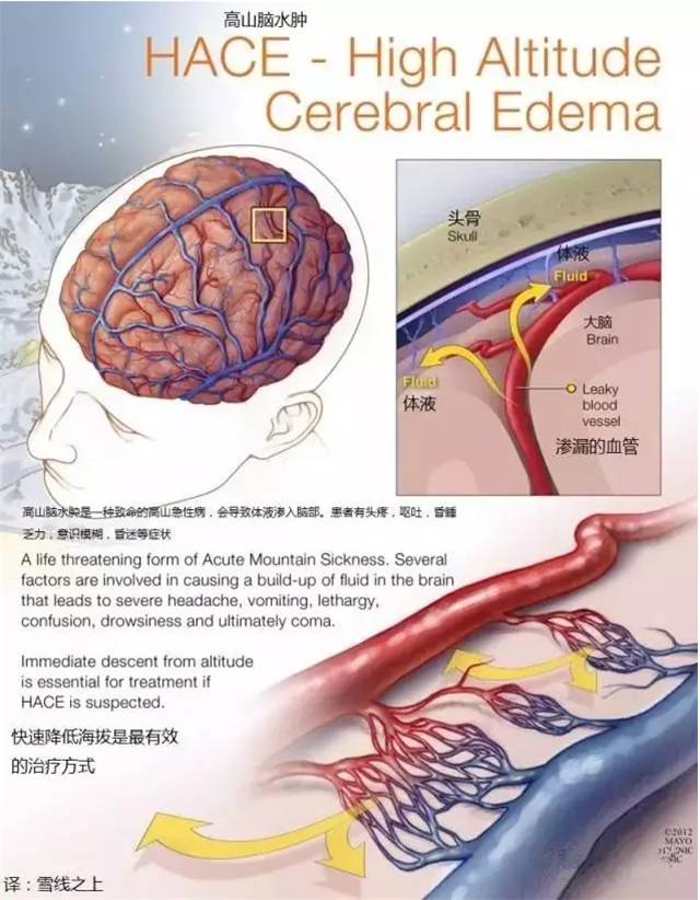 高原反应高血压怎样处理,高原反应心脏过快该怎么办