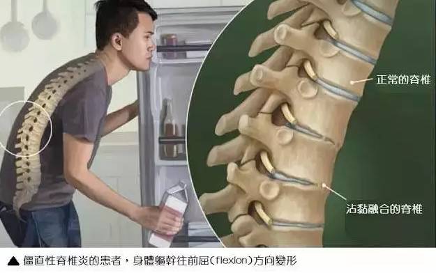 张嘉译的病是强直性脊柱炎吗,张嘉译强直性脊柱炎2019年视频