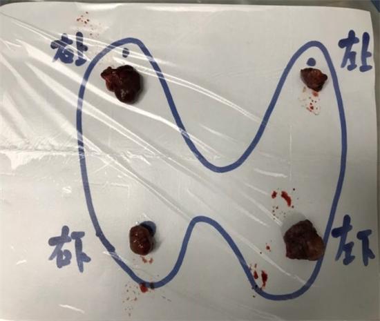 病理性骨折的常见病因,病理常见知识点