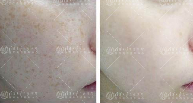点的雀斑留色素了怎么办,表皮雀斑怎么去除