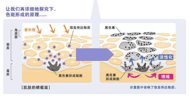 表皮部位色素治疗——遇到雀斑怎么办
