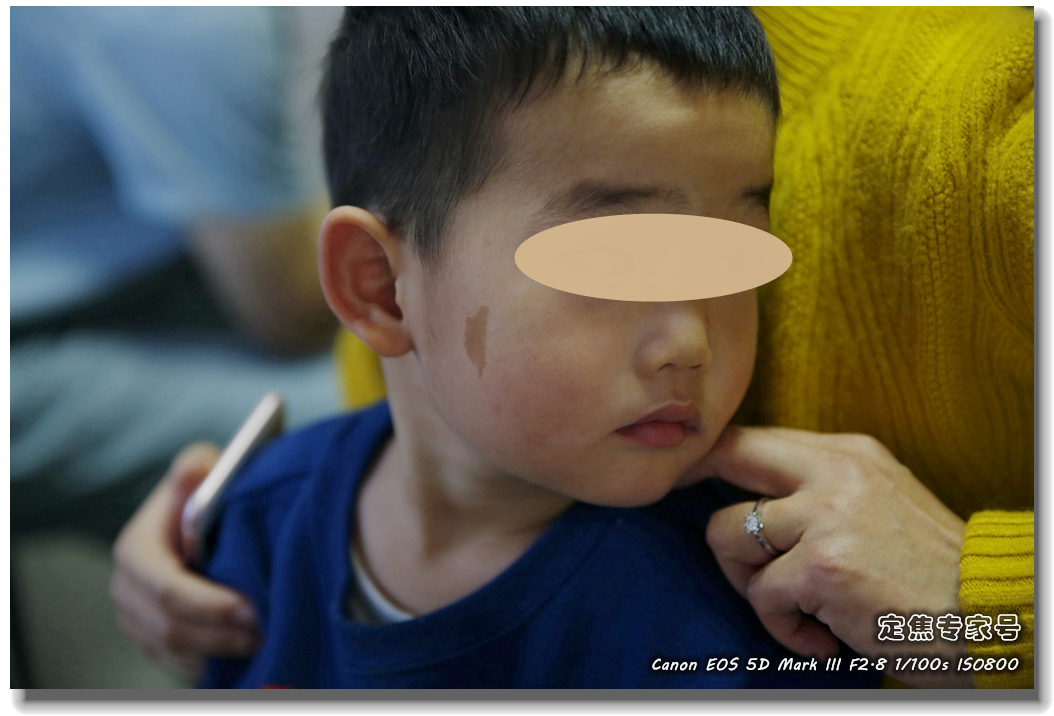 皮肤专家诊室故事连载之四，胳膊上一个小硬块能掏出多少东西？