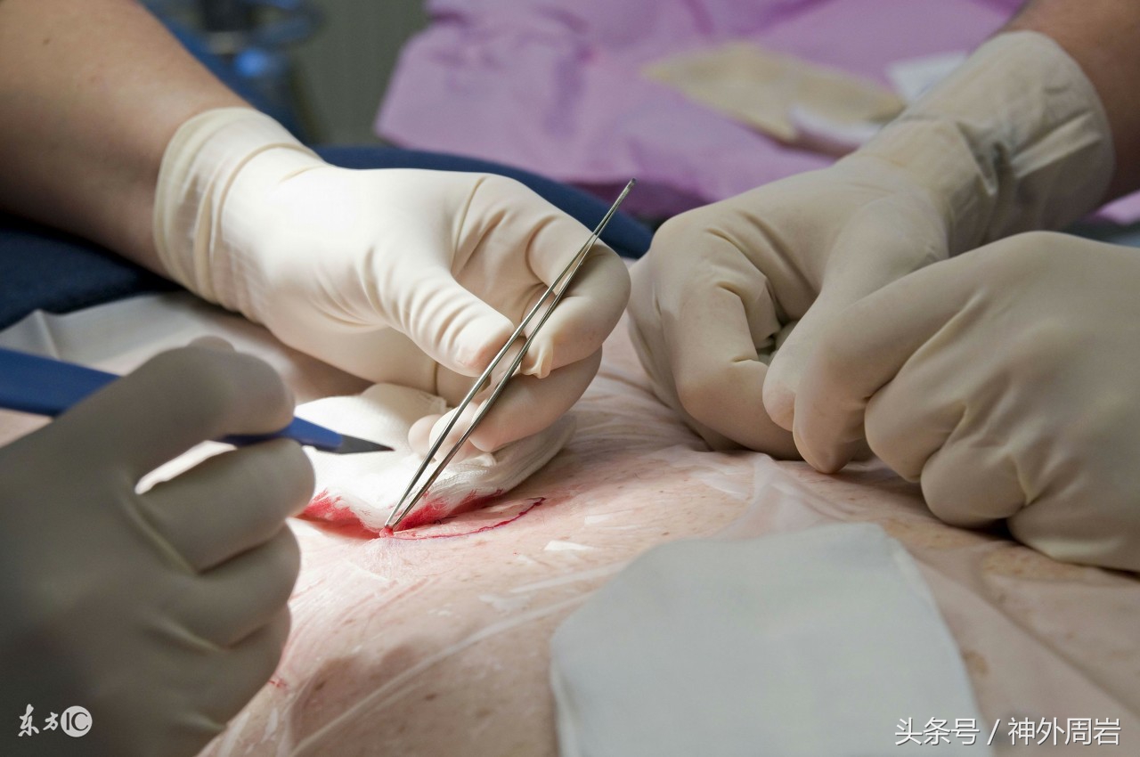 神经断裂后的再生痛苦,创伤性神经瘤症状和治疗