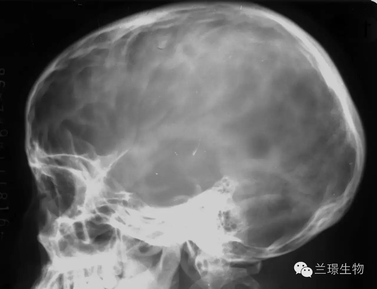 宣晟远程会诊：来自我们身体的药物——人血白蛋白