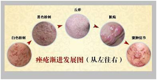 青春痘有什么方法解决,青春期已经长痘了怎么改善皮肤