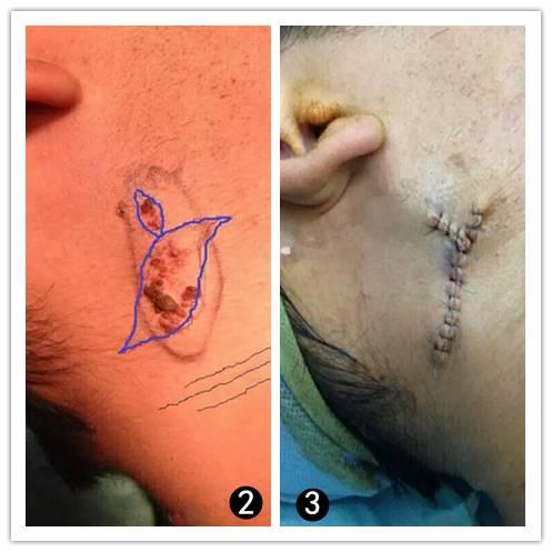 像小瘤一样的痣是什么,有个像疤一样的痣