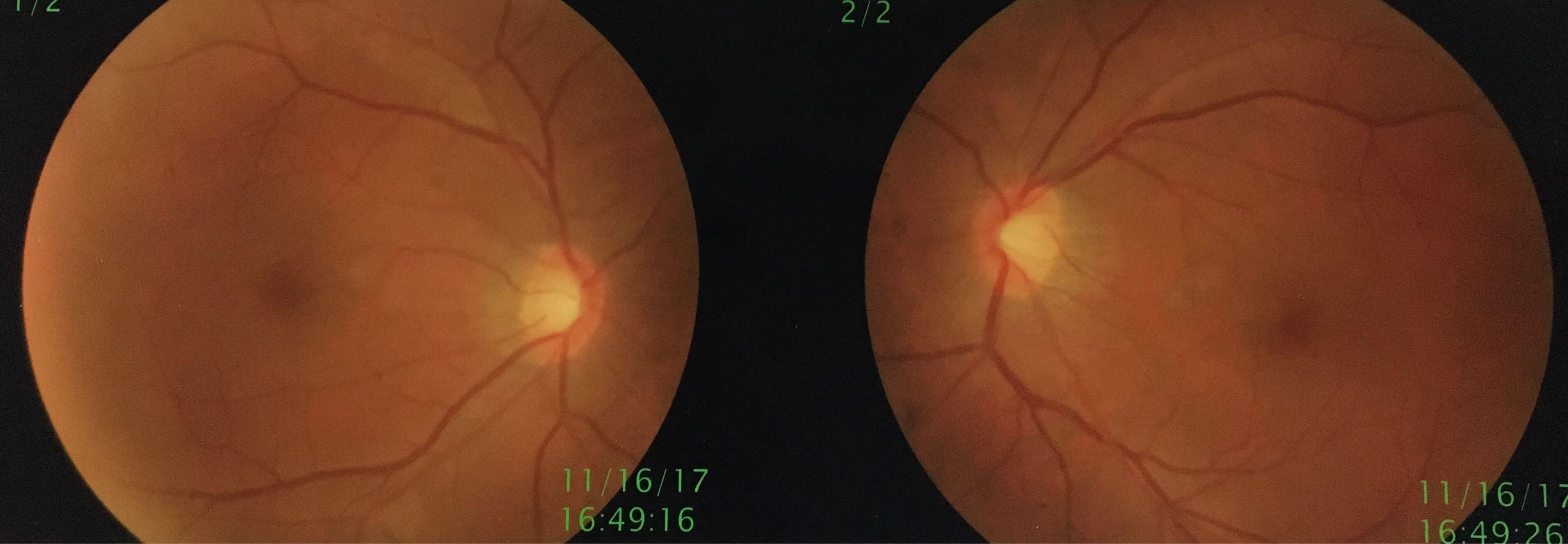 高度近视有必要恐慌吗,高度近视不戴眼镜的危害