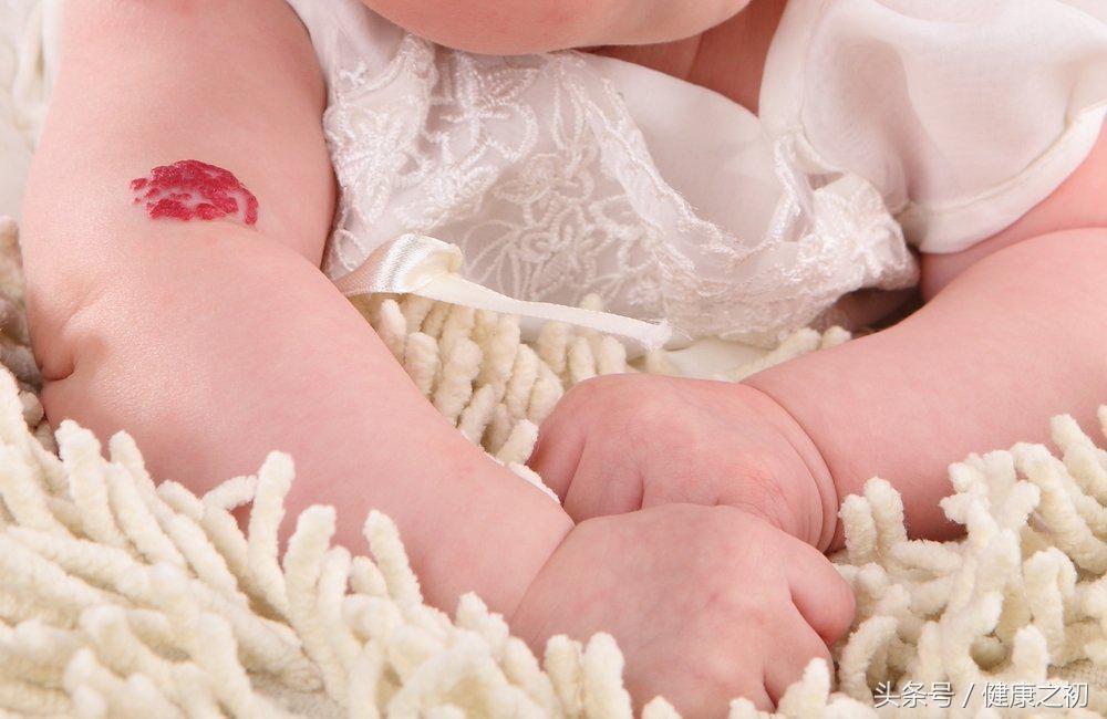 手上有血管瘤怎么消除,胎记血管瘤可以消除吗