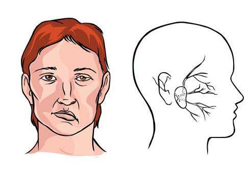 面部失去知觉是什么原因引起的,面部不好使了怎么回事