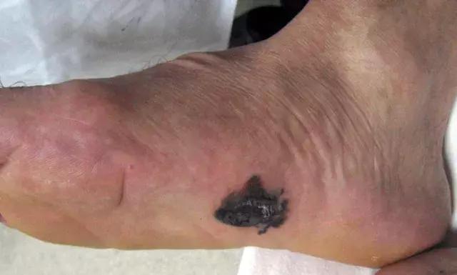 人中痣点痣过程,点痣要看痣图吗