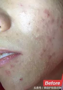 为什么一直反复长粉刺好了又长,脸上长粉刺如果什么都用会好吗