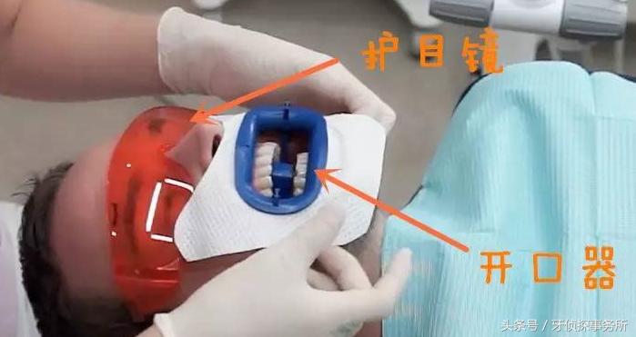 牙齿美白和冷光美白有啥区别,牙齿黄了很多年冷光美白仪有用吗