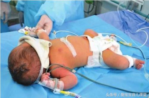 刚出生的婴儿得了溶血症,溶血症的孩子出生多久能发现