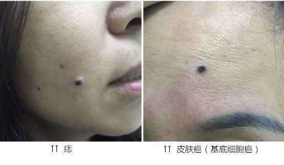 乳房上长的痣可以用激光点掉吗,什么样的痣适合激光点痣