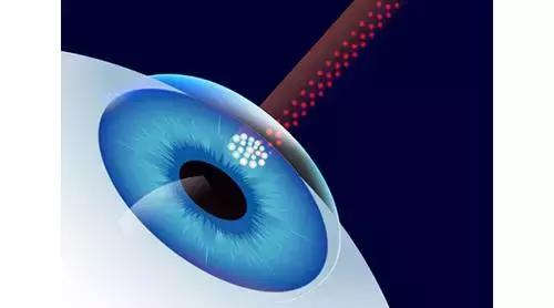 4种近视眼手术哪个最靠谱,成都近视眼手术价格一览表