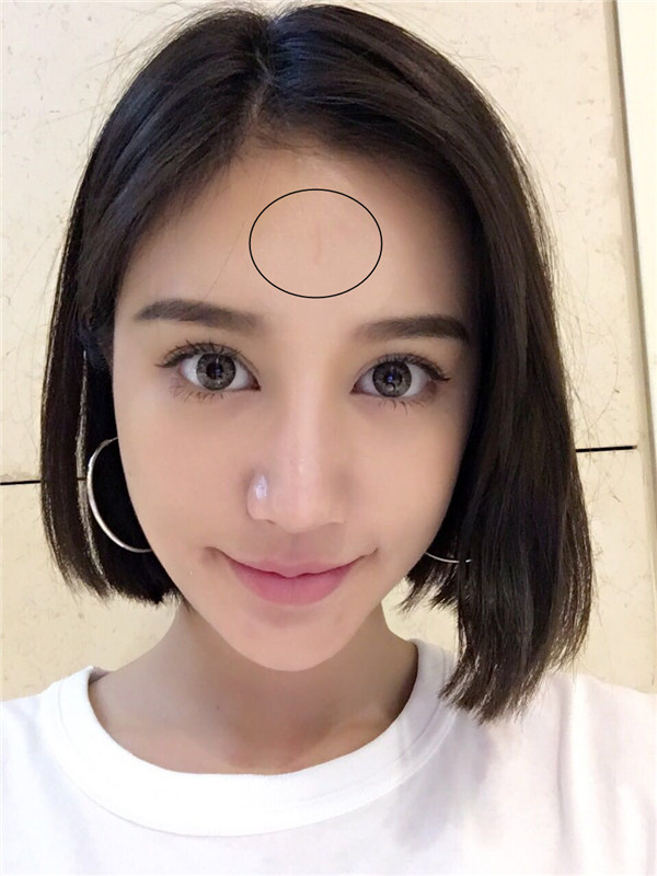 快速祛痘印小技巧,小妙招帮你祛痘印视频