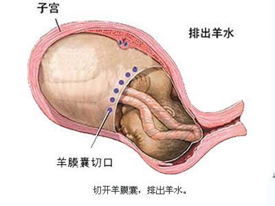 对于选择剖腹产的孕妈妈而言,到底剖腹产是怎样的?(图解)