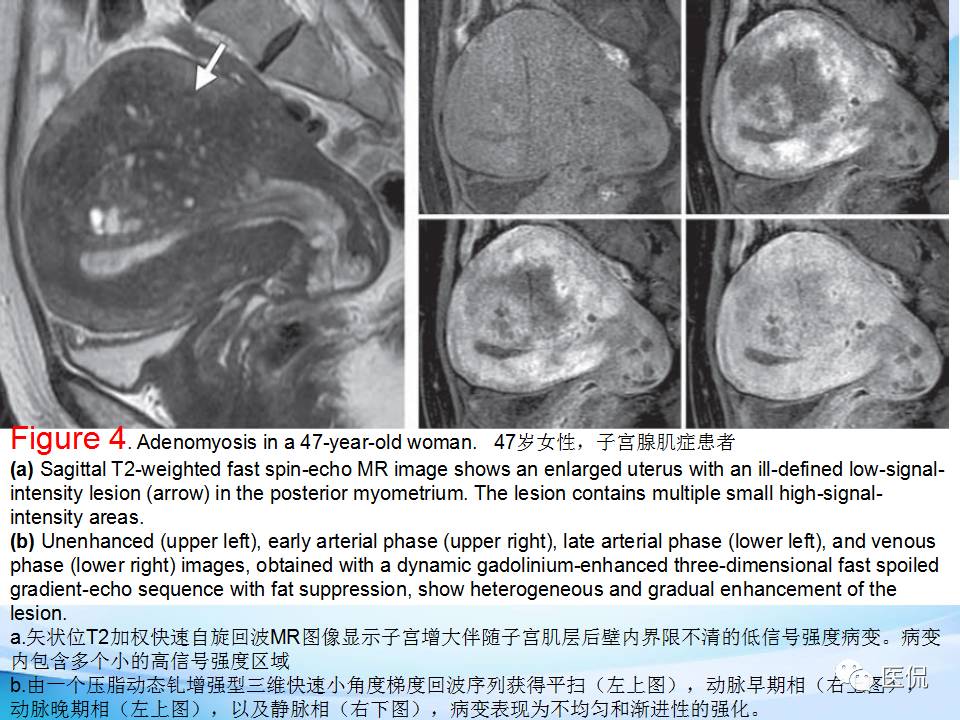 双语PPT：子宫腺肌症常见和不常见的MRI表现医学影像