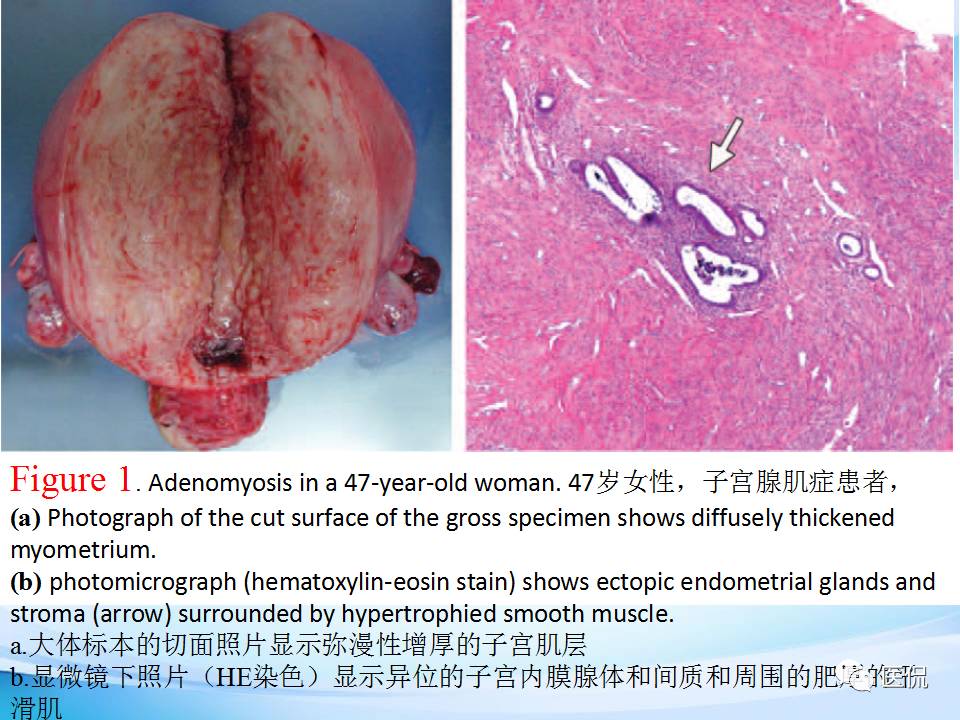 双语PPT：子宫腺肌症常见和不常见的MRI表现医学影像
