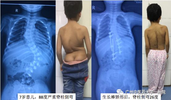 脊柱侧弯属于严重残疾吗,儿童脊柱侧弯去哪个医院好