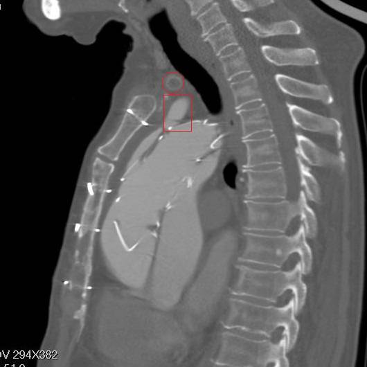 主动脉夹层袭来的恐慌,你不懂