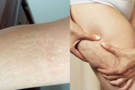 肥胖纹的解决方法,肥胖纹代表胖了还是瘦了
