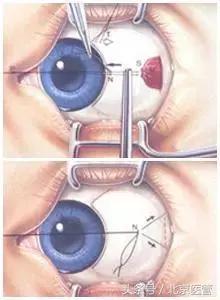 7岁儿童老是揉眼睛眨眼怎么回事,孩子眼睛斜视的最佳治疗方法