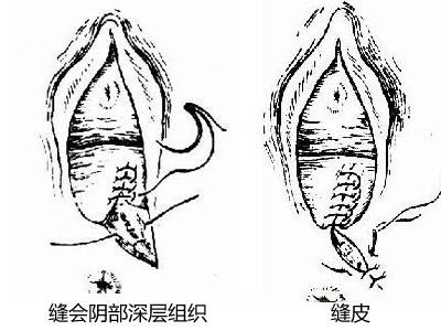 顺产也要挨一刀是真的吗,顺产为什么风险大