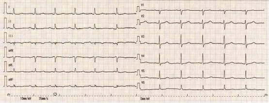 马长生房颤的最好治疗方法,马长生房颤消融后复发