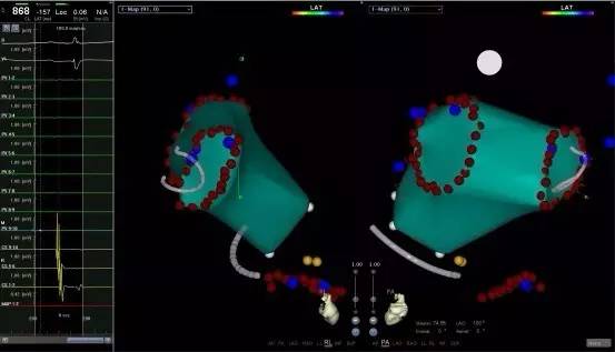 马长生房颤的最好治疗方法,马长生房颤消融后复发