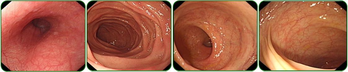 同为腹水，命运迥异