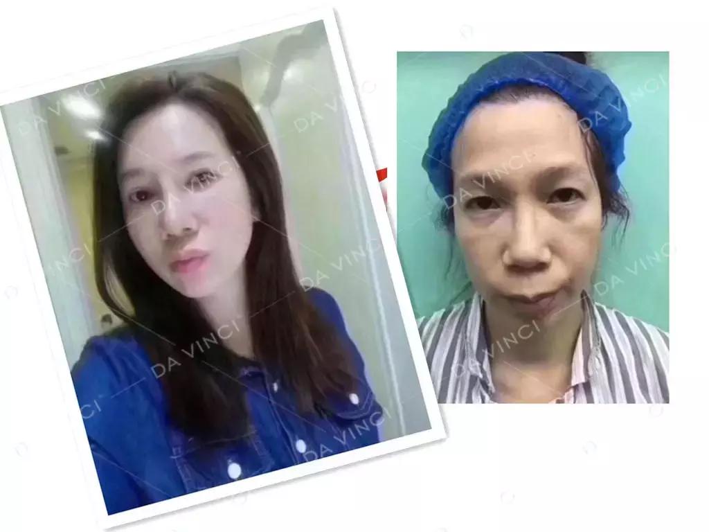 线雕提升的效果图,线雕青春定格术多久消肿