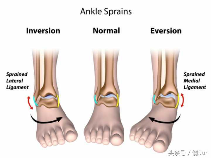 怎么避免脚踝习惯性扭伤,儿童脚踝反复扭伤