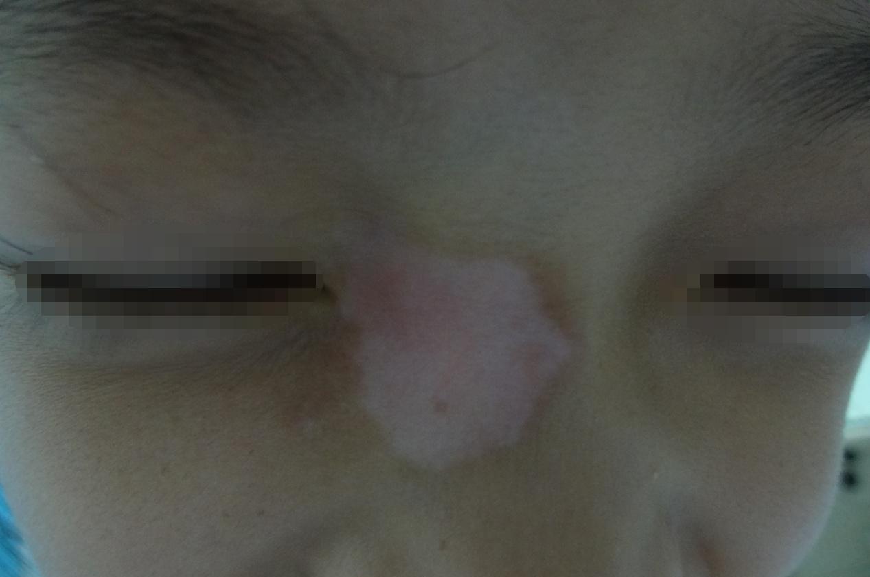 “爸爸，我爱你”——12岁的白癜风“老”患者的温情告白