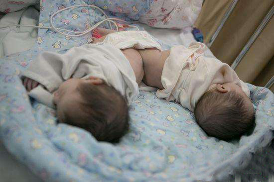 双胞胎畸形连体真实案例,胎儿连体可能由什么导致