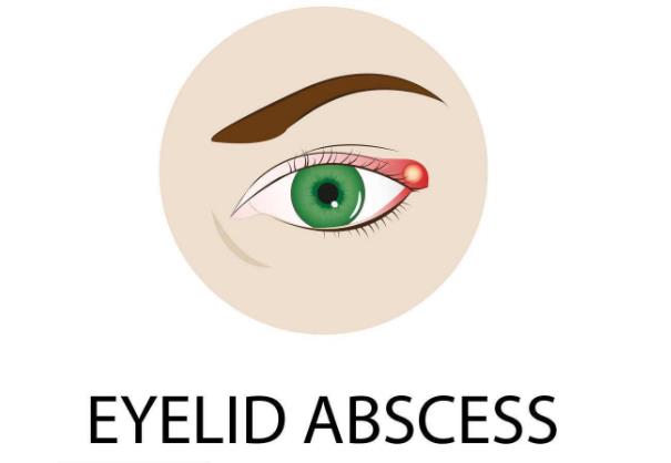 眼皮起麦粒肿什么病引起的,右眼长了麦粒肿有什么征兆