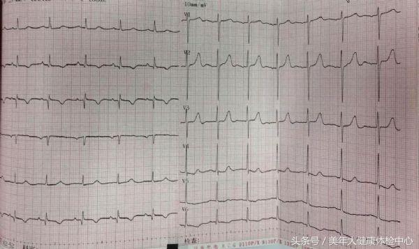 病例分享:服用华法林的月经期女性发生急性心肌梗死1例